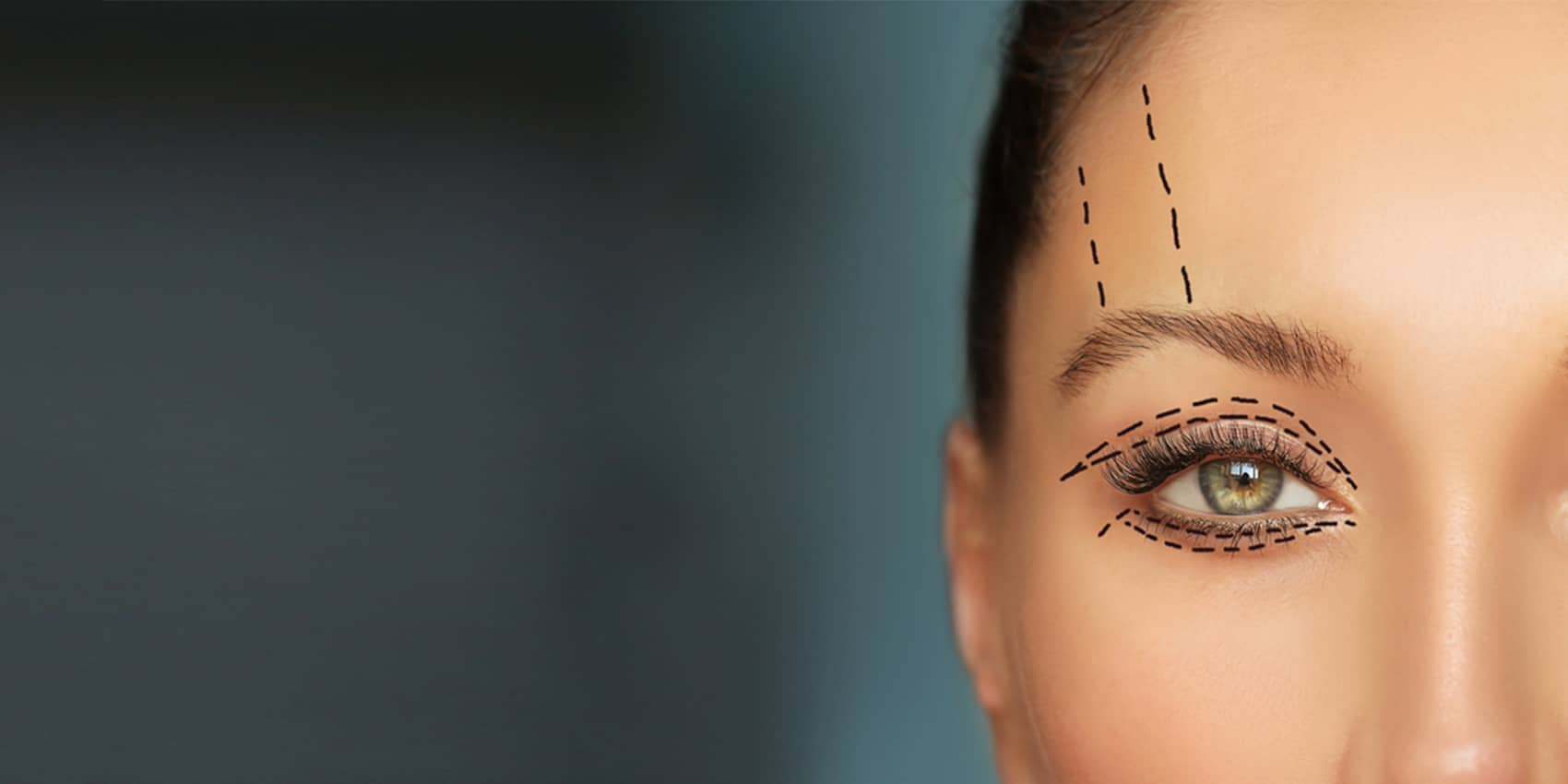 Blepharoplasty in Irvine, CA