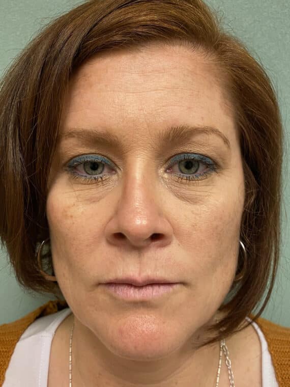 Before Blepharoplasty photo