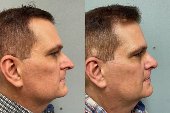 Rhinoplasty Before and After Photos in CA, Irvine, Patient 200