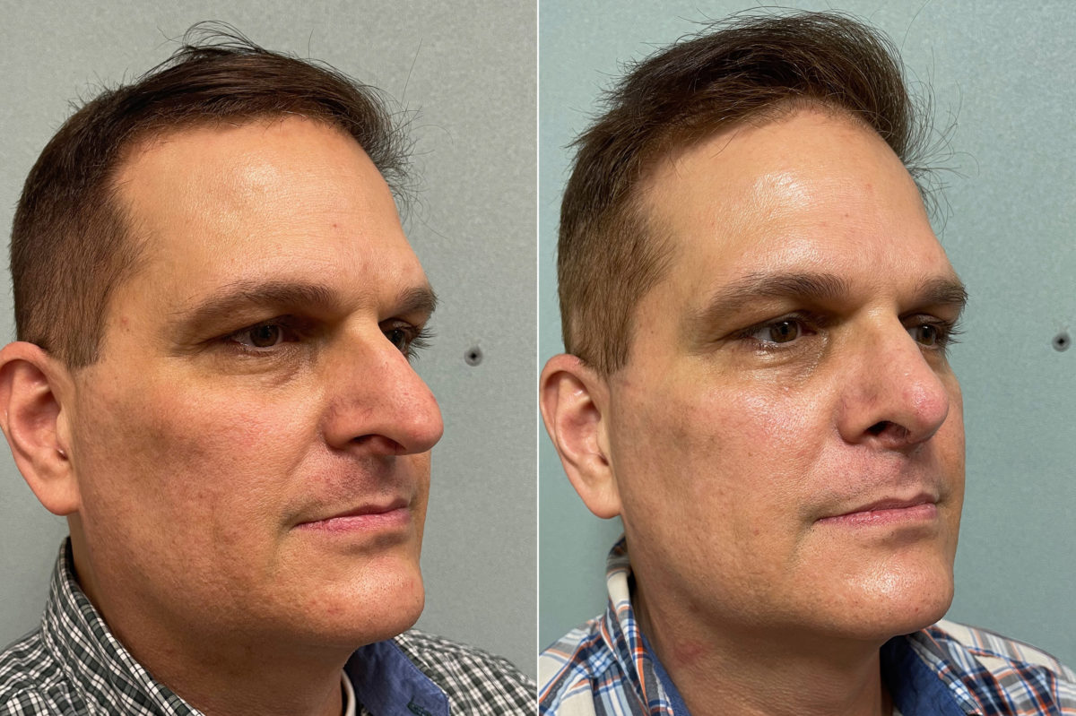 Rhinoplasty Before and After Photos in CA, Irvine, Patient 200