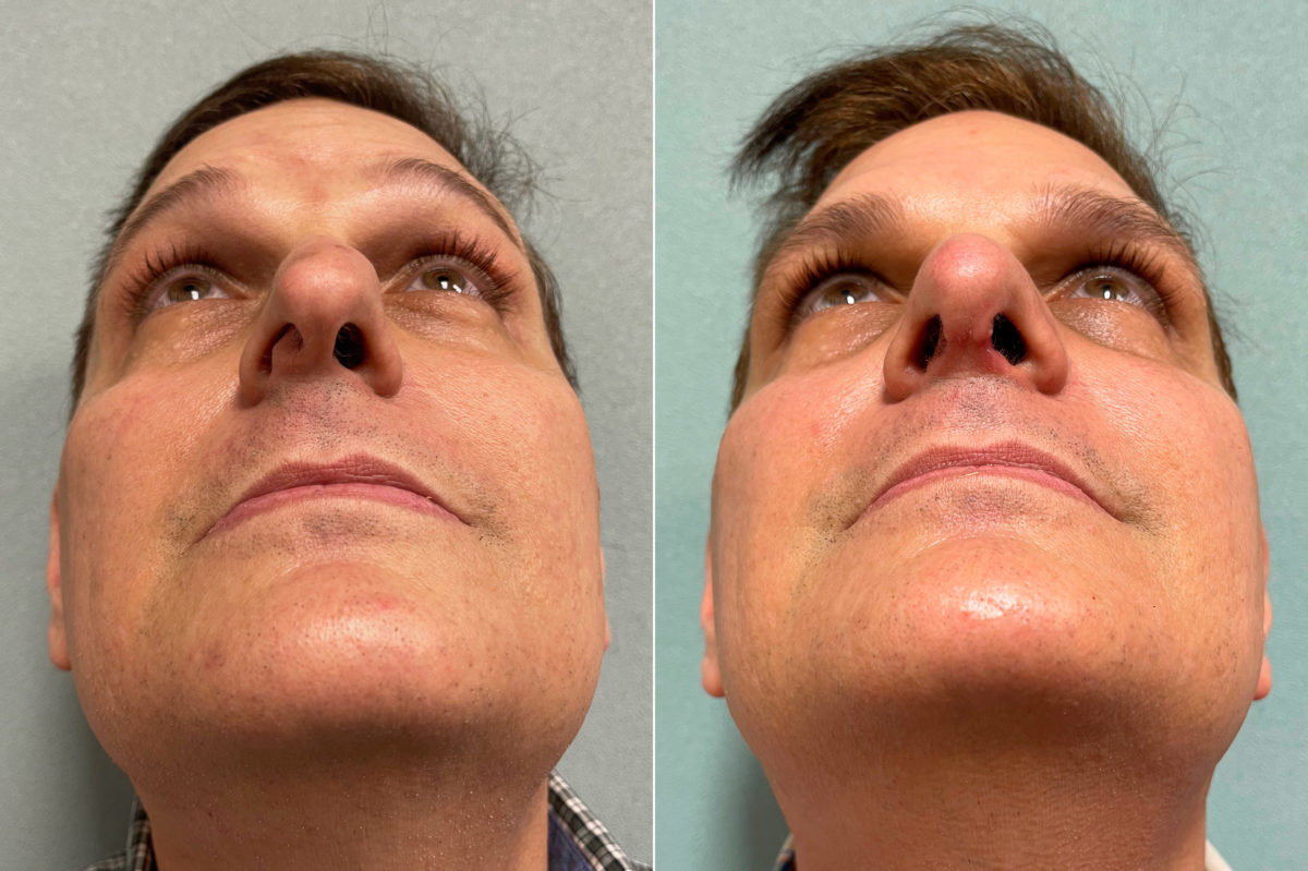 Rhinoplasty Before and After Photos in CA, Irvine, Patient 200