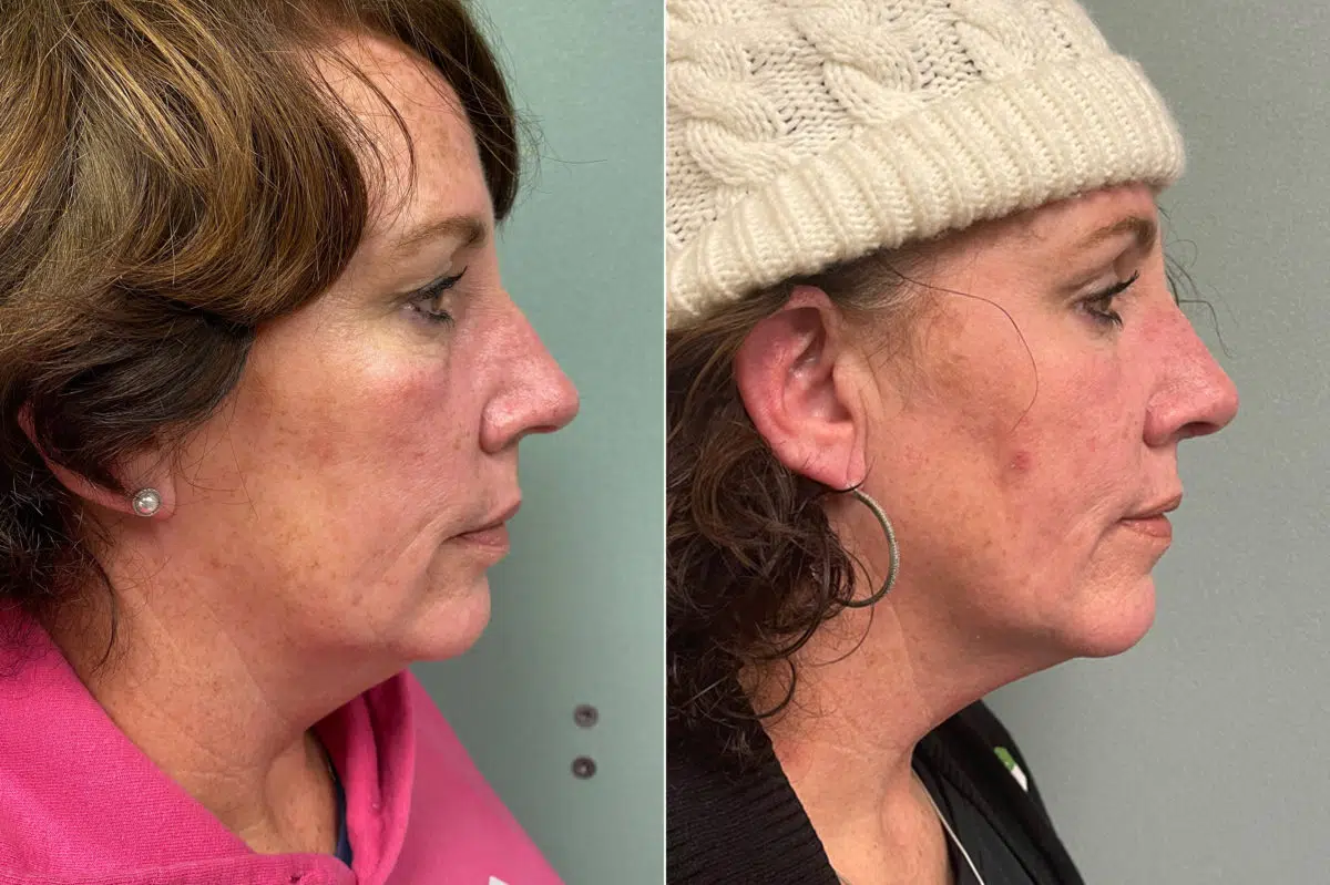 Rhinoplasty Before and After Photos in CA, Irvine, Patient 267