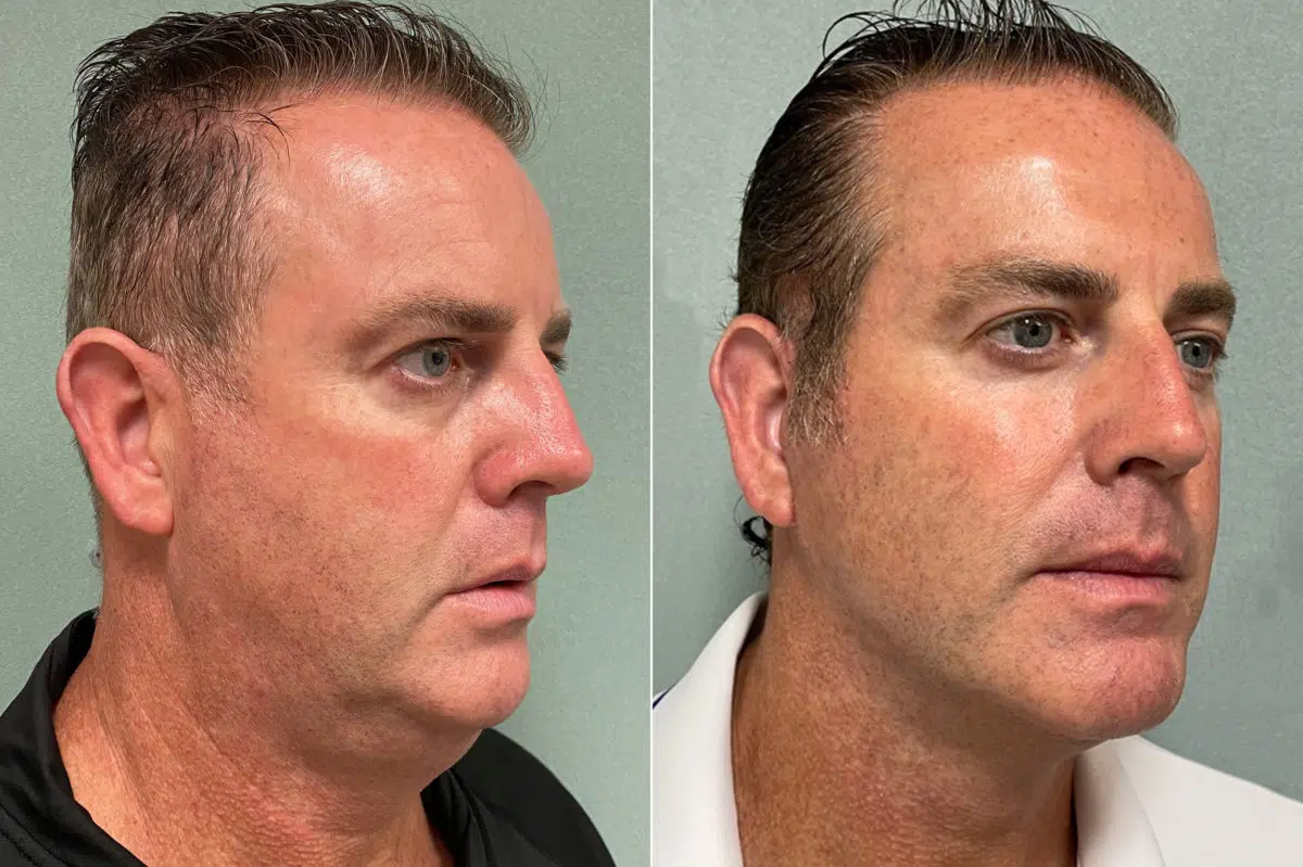 Facelift & Necklift Before and After Photos in CA, Irvine, Patient 268