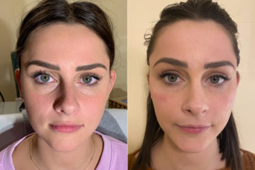 Injectables Before and After Photos in CA, Irvine, Patient 296