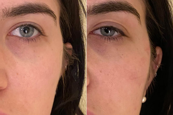 Injectables Before and After Photos in CA, Irvine, Patient 317