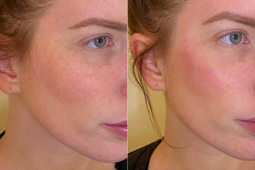 Injectables Before and After Photos in CA, Irvine, Patient 318