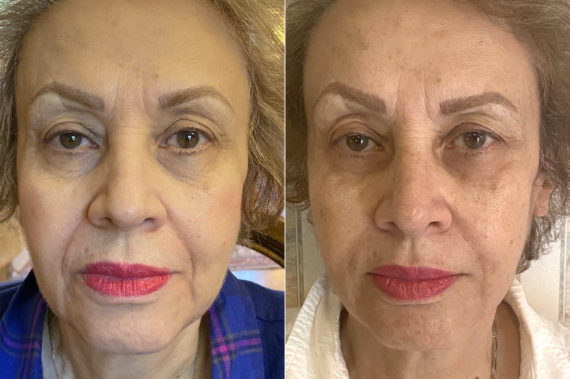 Injectables Before and After Photos in CA, Irvine, Patient 341