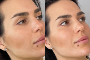 Injectables Before and After Photos in CA, Irvine, Patient 660