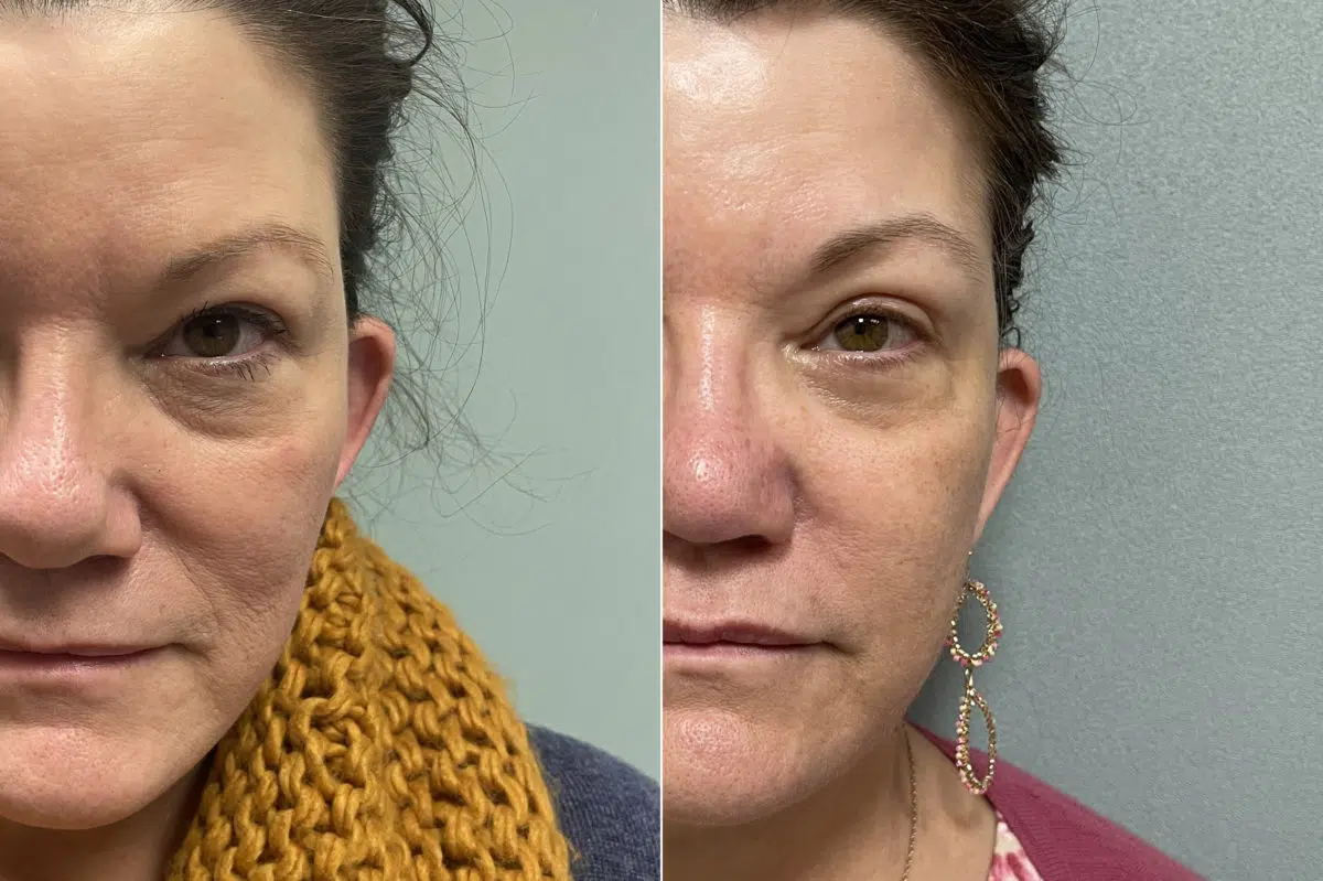 Blepharoplasty Before and After Photos in CA, Irvine, Patient 252