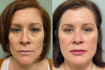 Blepharoplasty Before and After Photos in CA, Irvine, Patient 253