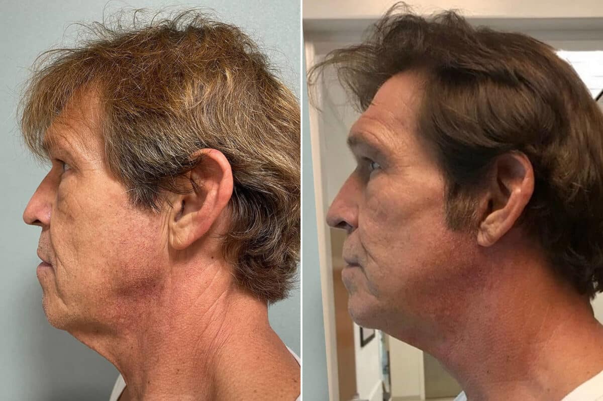 Facelift & Necklift Before and After Photos in CA, Irvine, Patient 266