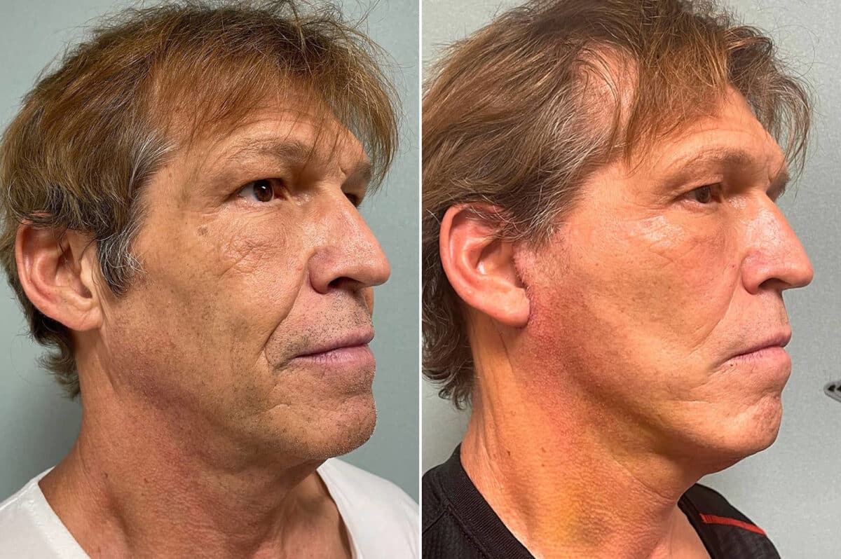 Facelift & Necklift Before and After Photos in CA, Irvine, Patient 266