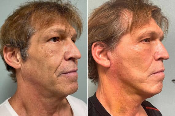 Facelift & Necklift Before and After Photos in CA, Irvine, Patient 266