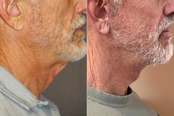 Facelift & Necklift Before and After Photos in CA, Irvine, Patient 1056