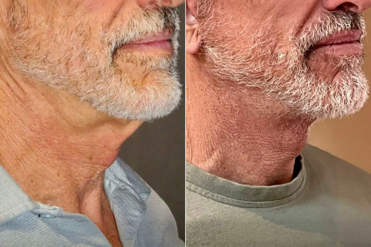 Facelift & Necklift Before and After Photos in CA, Irvine, Patient 1056