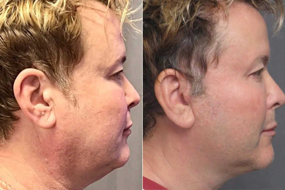 Facelift & Necklift Before and After Photos in CA, Irvine, Patient 1216