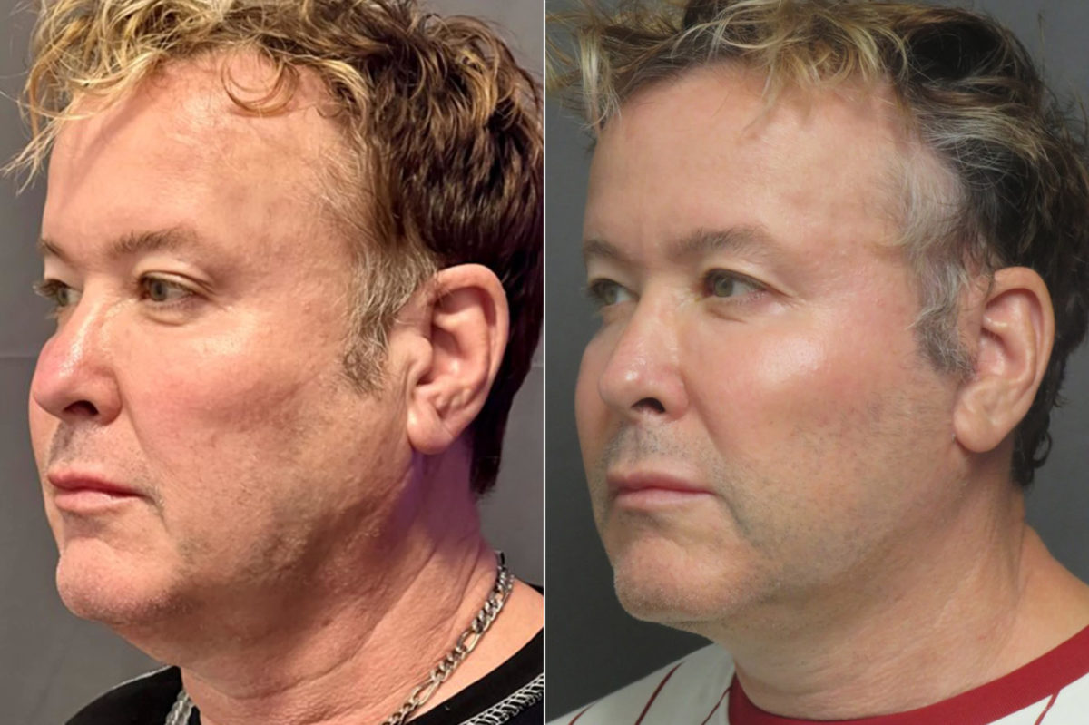 Facelift & Necklift Before and After Photos in CA, Irvine, Patient 1216