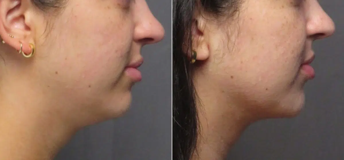 Double Chin Lipo Before and After Photos in CA, Irvine, Patient 1235