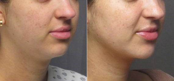 Double Chin Lipo Before and After Photos in CA, Irvine, Patient 1235