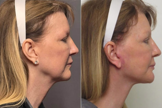 Facelift & Necklift Before and After Photos in CA, Irvine, Patient 1256