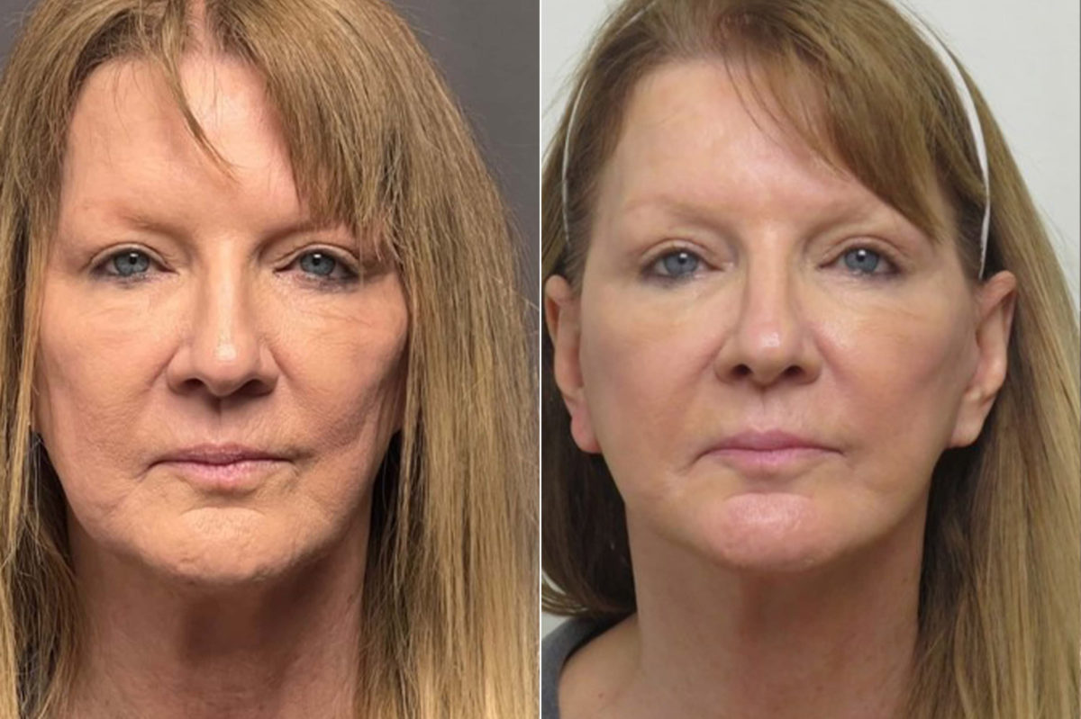 Facelift & Necklift Before and After Photos in CA, Irvine, Patient 1256