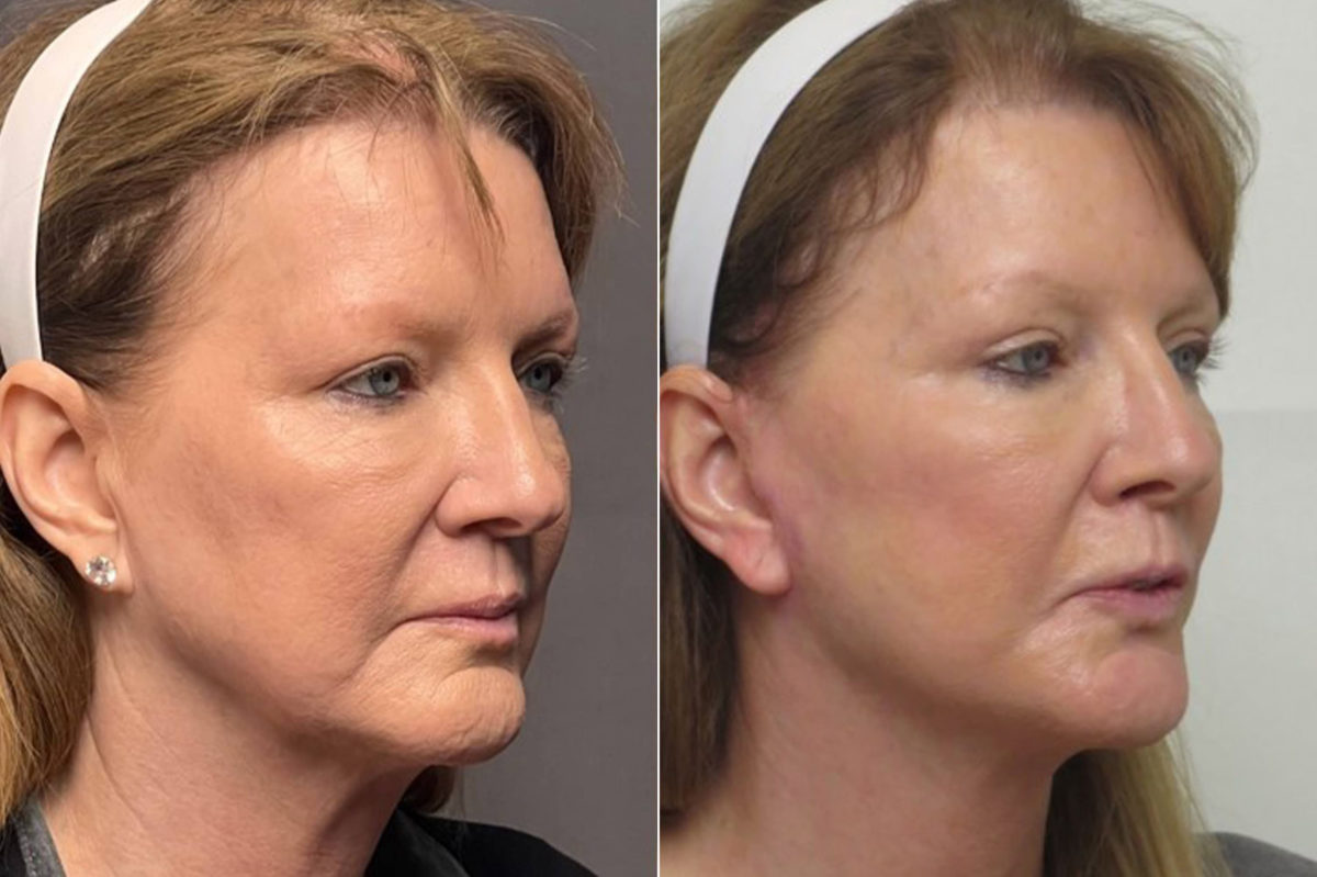 Facelift & Necklift Before and After Photos in CA, Irvine, Patient 1256