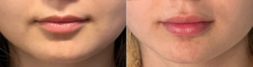 Lip Filler Before and After Photos in CA, Irvine, Patient 1082