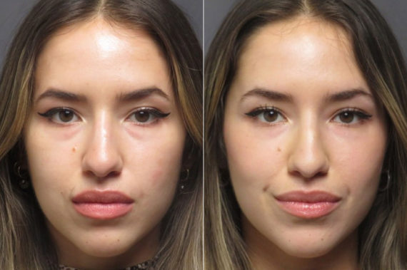 Under-eye filler Before and After Photos in CA, Irvine, Patient 1228