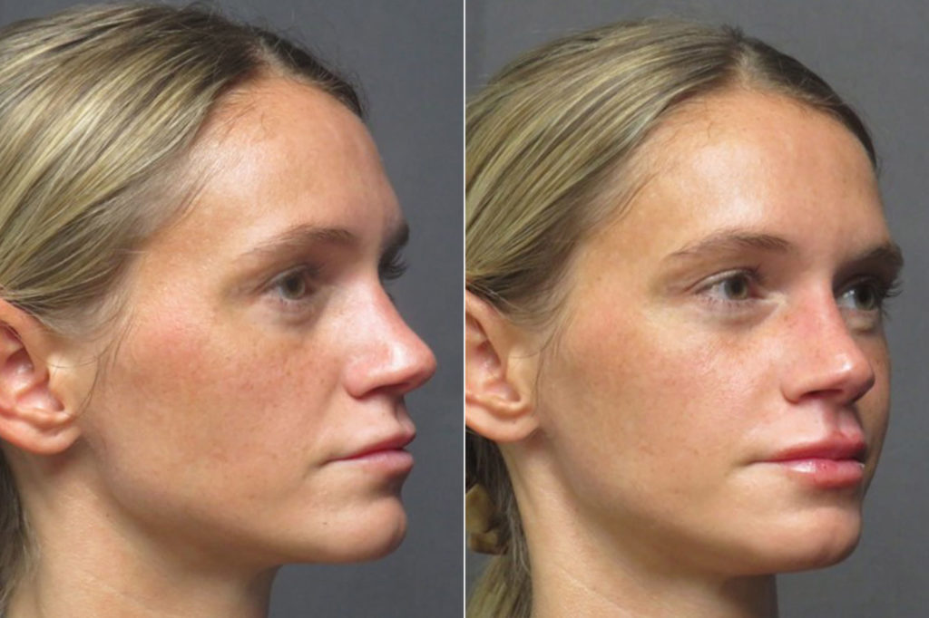 Lip Filler Photos Hollywood, CA Patient 1271