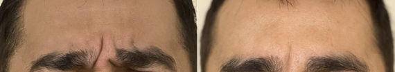 Botox / Dysport Before and After Photos in CA, Irvine, Patient 298