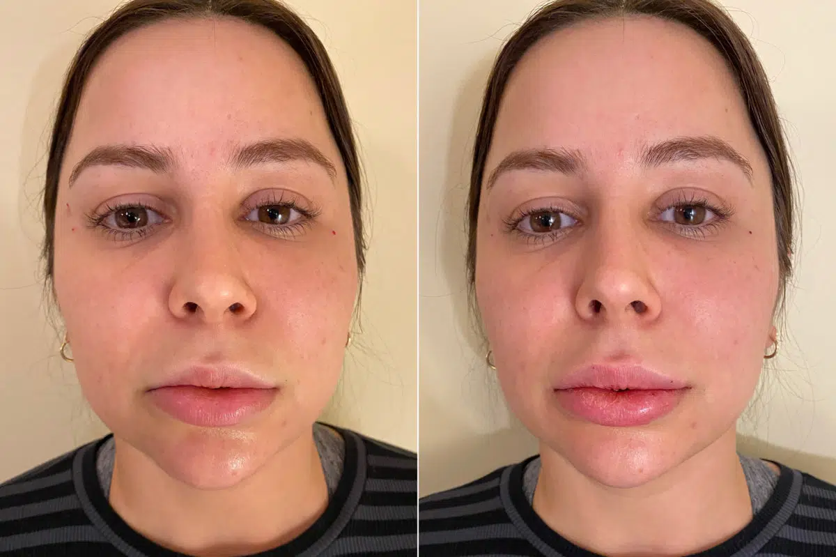 Lip Filler Before and After Photos in CA, Irvine, Patient 319