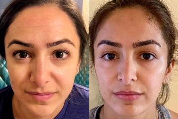 Lip Filler Before and After Photos in CA, Irvine, Patient 329