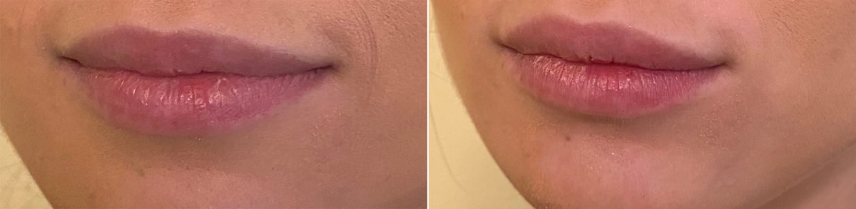 Lip Filler Before and After Photos in CA, Irvine, Patient 355