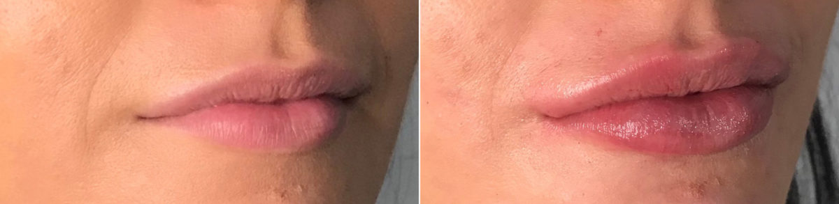 Lip Filler Before and After Photos in CA, Irvine, Patient 640