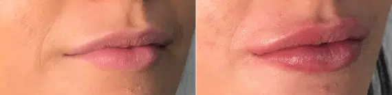 Lip Filler Before and After Photos in CA, Irvine, Patient 640