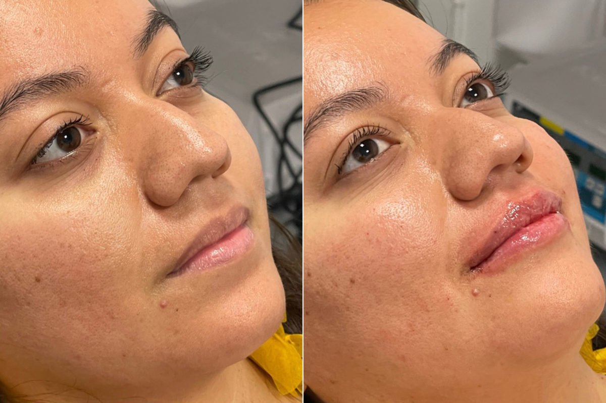 Lip Filler Before and After Photos in CA, Irvine, Patient 644