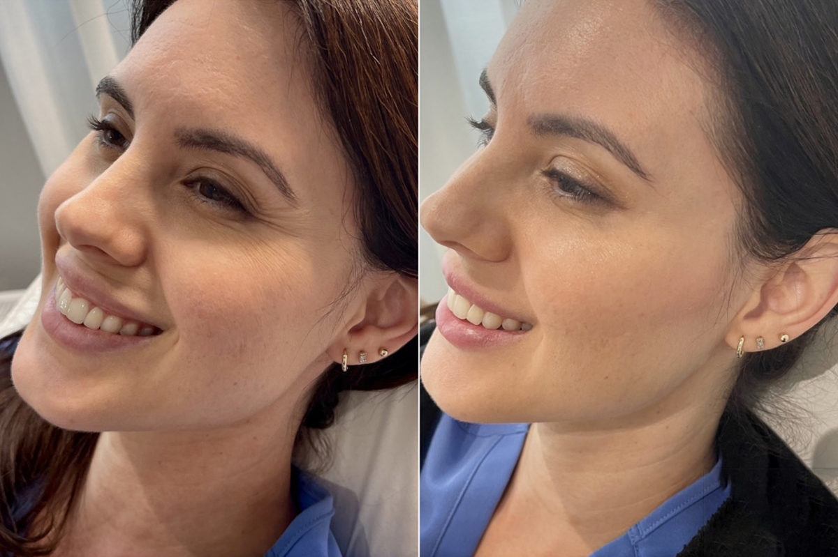 Botox / Dysport Before and After Photos in CA, Irvine, Patient 648