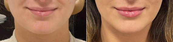 Lip Filler Before and After Photos in CA, Irvine, Patient 656