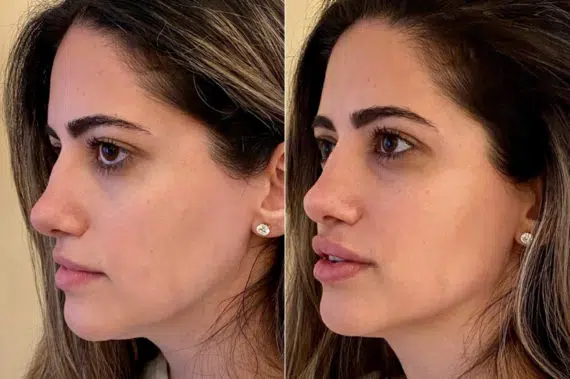 Lip Filler Before and After Photos in CA, Irvine, Patient 664