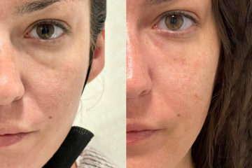 Under-eye filler Before and After Photos in CA, Irvine, Patient 668