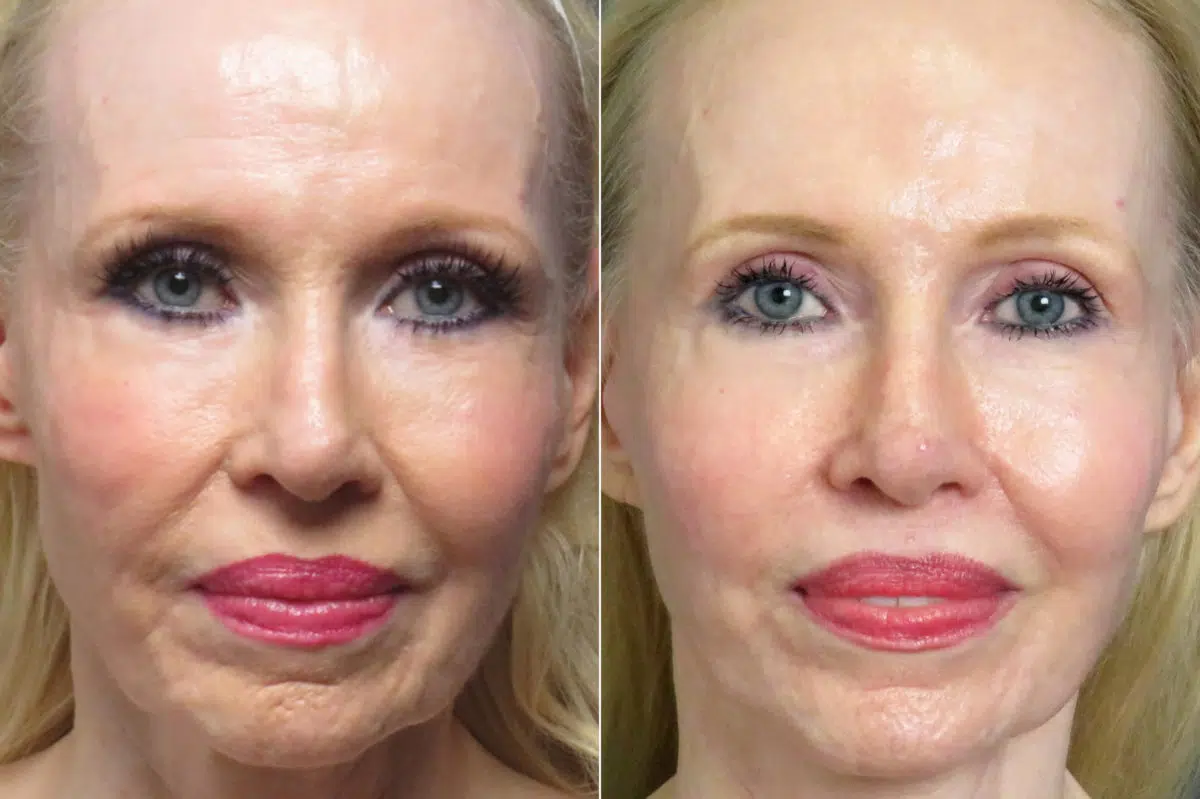 Facelift & Necklift Before and After Photos in CA, Irvine, Patient 1247