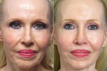 Facelift & Necklift Before and After Photos in CA, Irvine, Patient 1247