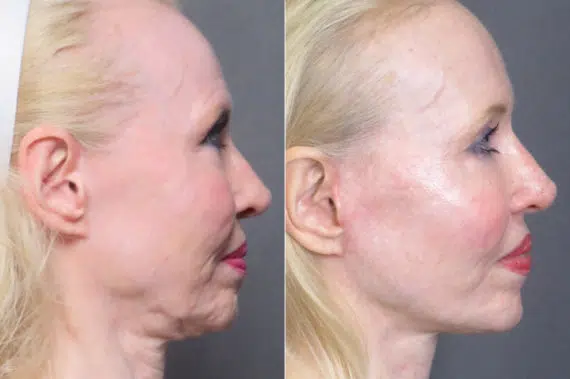 Facelift & Necklift Before and After Photos in CA, Irvine, Patient 1247