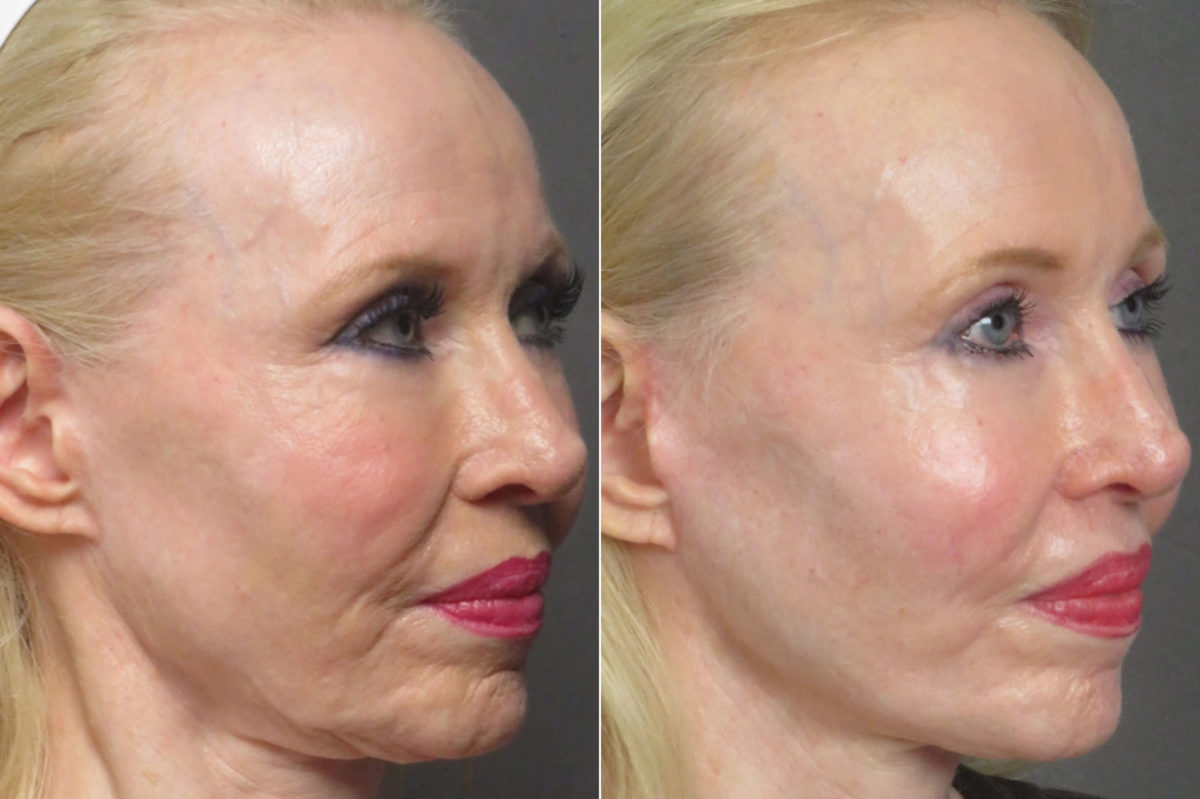 Facelift & Necklift Before and After Photos in CA, Irvine, Patient 1247