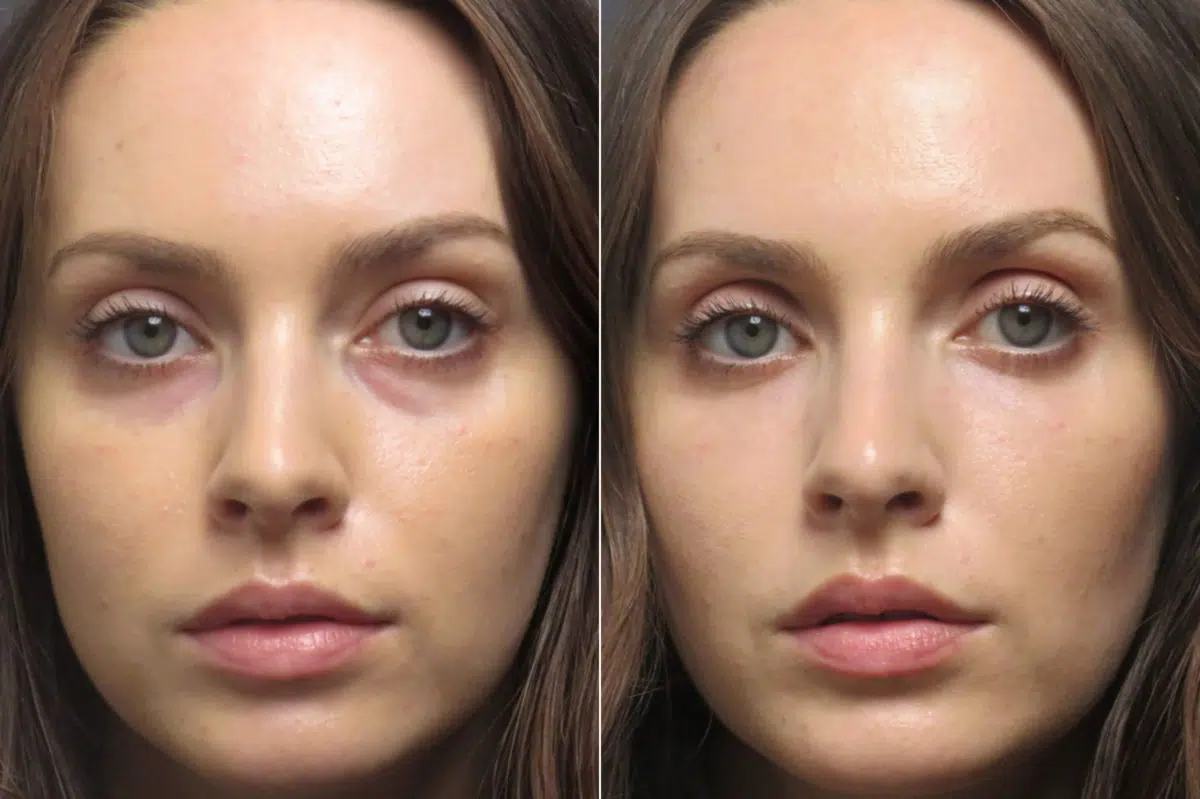 Under-eye filler Before and After Photos in CA, Irvine, Patient 1463