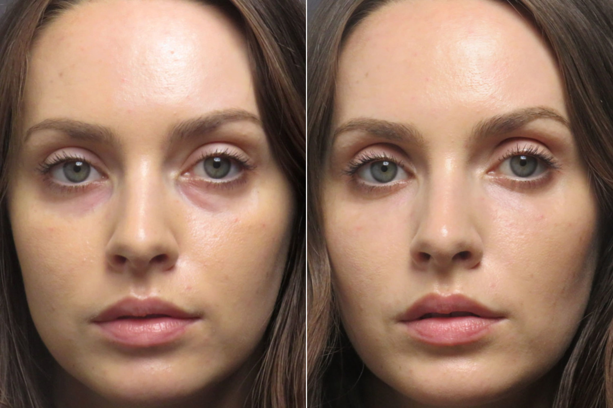Undereye filler Photos SoCal Aesthetic Surgery