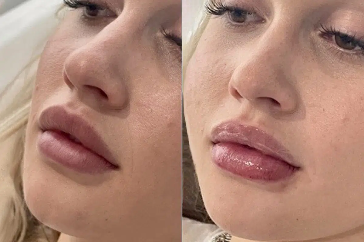 Lip Filler Before and After Photos in CA, Irvine, Patient 652