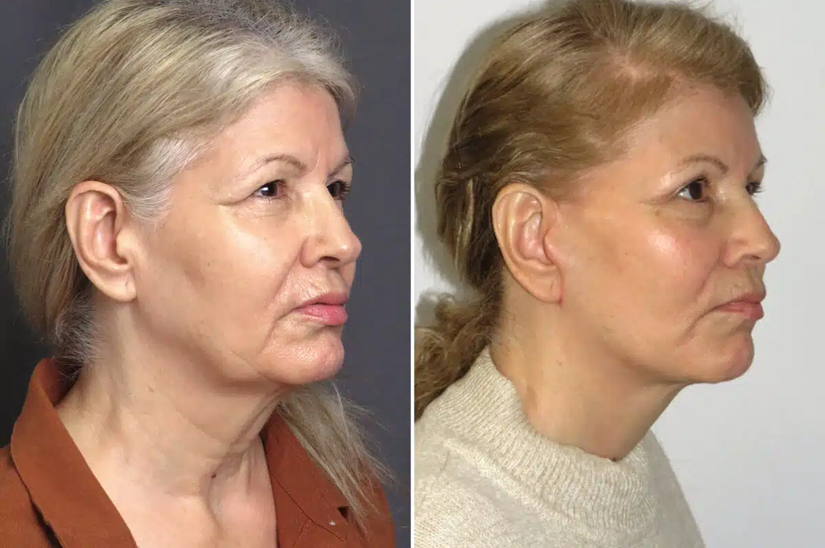 Facelift & Necklift Before and After Photos in CA, Irvine, Patient 1532