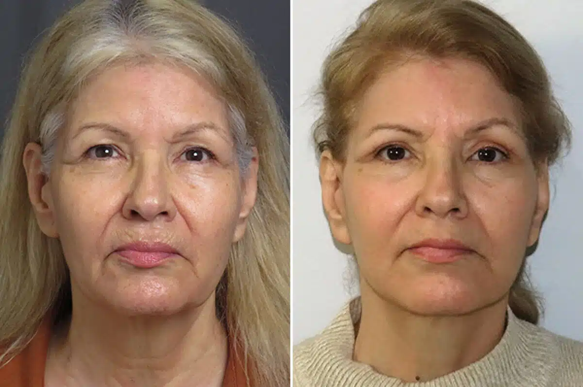 Facelift & Necklift Before and After Photos in CA, Irvine, Patient 1532