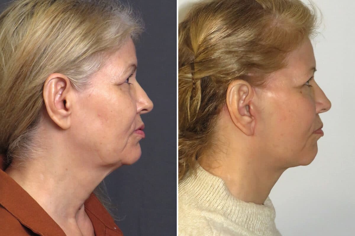 Facelift & Necklift Before and After Photos in CA, Irvine, Patient 1532